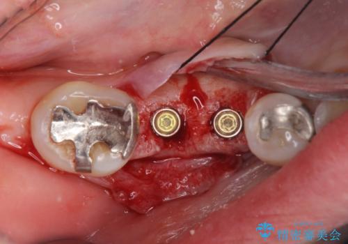 歯槽堤保存術 → インプラント治療の治療中