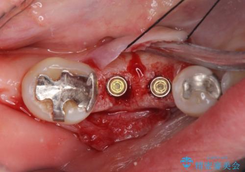歯槽堤保存術 → インプラント治療の治療中