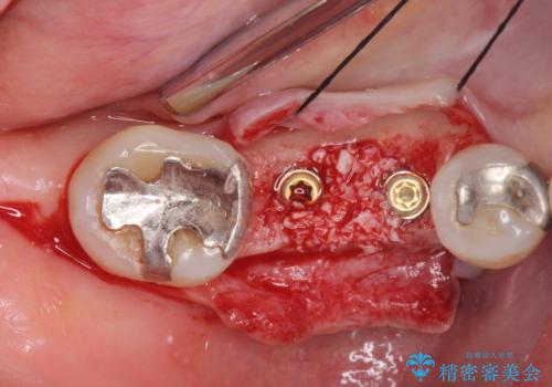 歯槽堤保存術 → インプラント治療の治療中