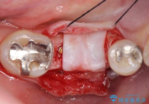 歯槽堤保存術 → インプラント治療の治療後