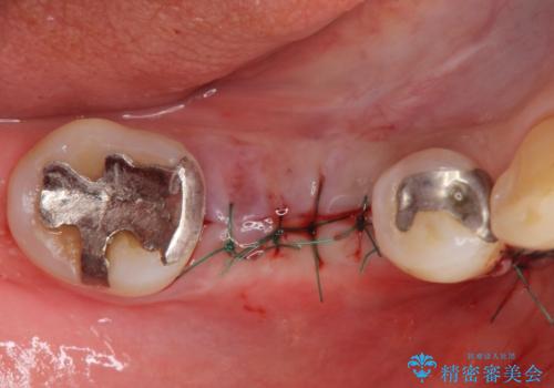 歯槽堤保存術 → インプラント治療の治療後
