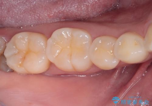 親知らずに影響で大きなむし歯に セラミッククラウンによるむし歯治療の症例 治療前