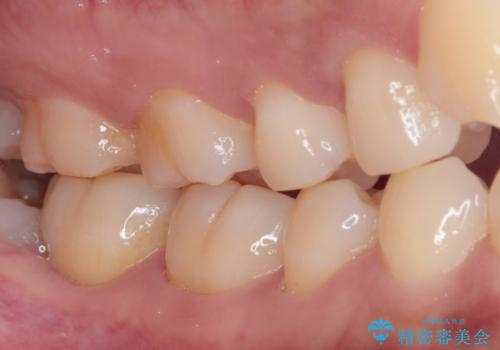 親知らずに影響で大きなむし歯に セラミッククラウンによるむし歯治療の治療前
