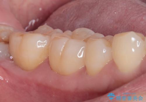 親知らずに影響で大きなむし歯に セラミッククラウンによるむし歯治療の治療前