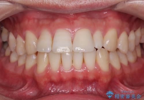 つぎはぎだらけの前歯を周囲と調和させたい オールセラミッククラウン補綴治療の治療後