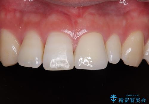 つぎはぎだらけの前歯を周囲と調和させたい　オールセラミッククラウン補綴治療の症例 治療後
