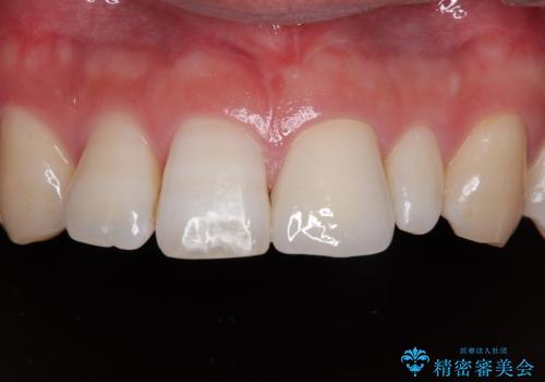 つぎはぎだらけの前歯を周囲と調和させたい オールセラミッククラウン補綴治療の症例 治療後