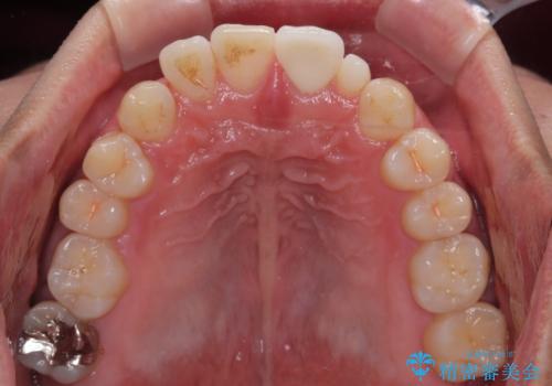 つぎはぎだらけの前歯を周囲と調和させたい　オールセラミッククラウン補綴治療の治療後