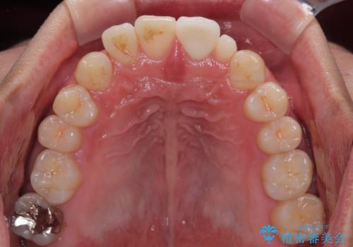 つぎはぎだらけの前歯を周囲と調和させたい オールセラミッククラウン補綴治療の治療後