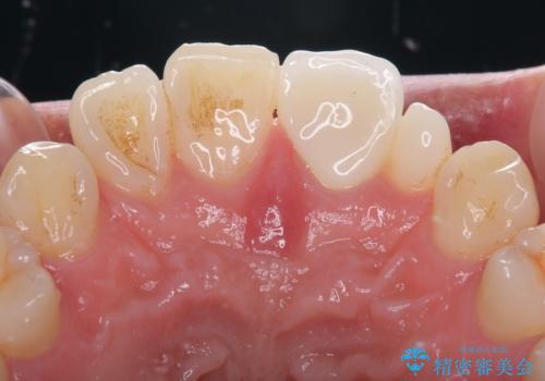つぎはぎだらけの前歯を周囲と調和させたい　オールセラミッククラウン補綴治療の治療後