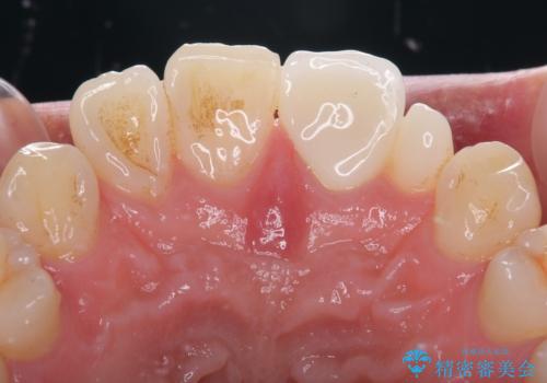 つぎはぎだらけの前歯を周囲と調和させたい オールセラミッククラウン補綴治療の治療後