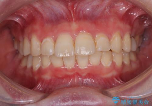 インビザラインが続けられない ワイヤー矯正に切り替えてデコボコを改善の症例 治療後