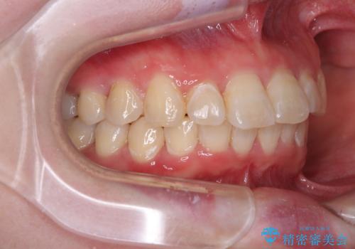 インビザラインが続けられない ワイヤー矯正に切り替えてデコボコを改善の治療後