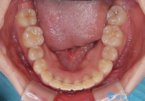 インビザラインが続けられない　ワイヤー矯正に切り替えてデコボコを改善の治療後