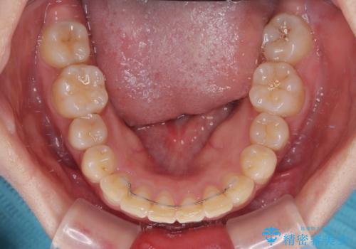 インビザラインが続けられない ワイヤー矯正に切り替えてデコボコを改善の治療後