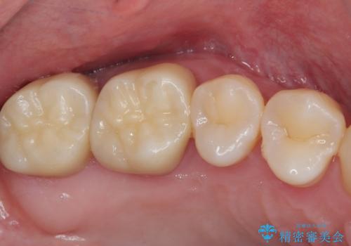 奥歯が痛い　オールセラミッククラウンでのむし歯治療の治療後