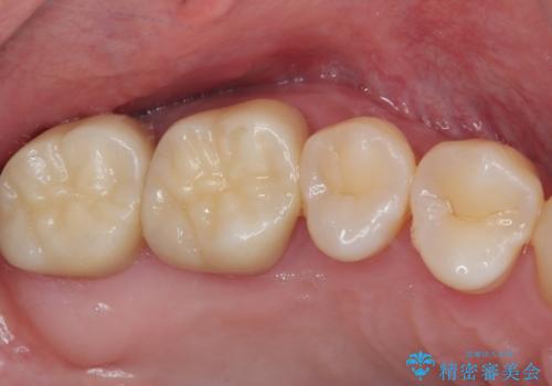奥歯が痛い オールセラミッククラウンでのむし歯治療の治療後