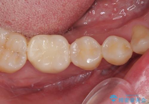 奥歯が痛い オールセラミッククラウンでのむし歯治療の治療後