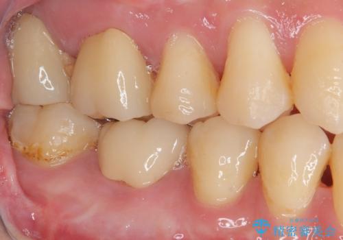 奥歯が痛い オールセラミッククラウンでのむし歯治療の治療後
