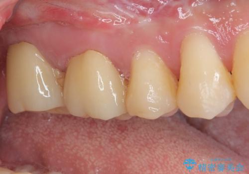 奥歯が痛い　オールセラミッククラウンでのむし歯治療の治療後