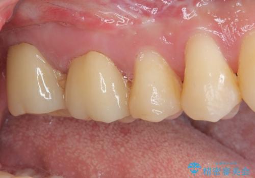 奥歯が痛い オールセラミッククラウンでのむし歯治療の治療後