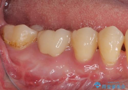 奥歯が痛い オールセラミッククラウンでのむし歯治療の治療後