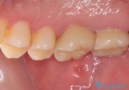 奥歯が痛い オールセラミッククラウンでのむし歯治療の治療後