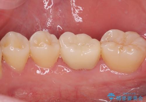 奥歯が痛い オールセラミッククラウンでのむし歯治療の治療後