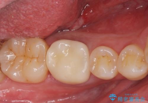 ジルコニアクラウンの症例 治療後