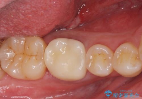 ジルコニアクラウンの治療後
