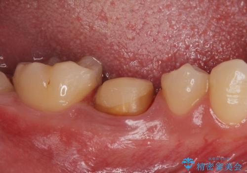 ジルコニアクラウンの治療中