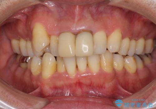 八重歯と突出感を改善 ワイヤー装置での矯正治療の症例 治療前