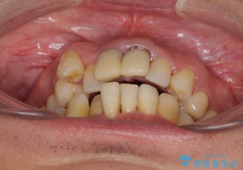 八重歯と突出感を改善 ワイヤー装置での矯正治療の治療前