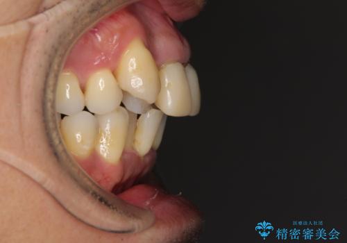 八重歯と突出感を改善 ワイヤー装置での矯正治療の治療前