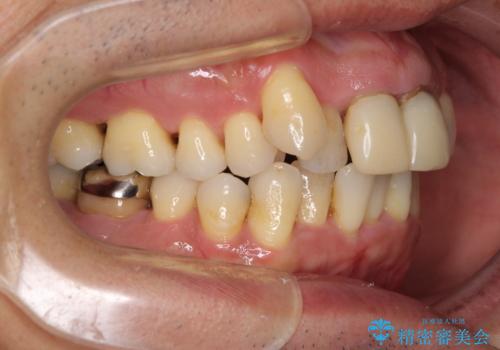 八重歯と突出感を改善 ワイヤー装置での矯正治療の治療前