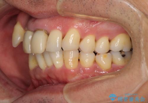 八重歯と突出感を改善 ワイヤー装置での矯正治療の治療前