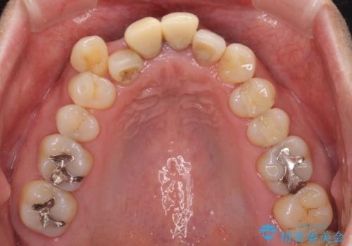 八重歯と突出感を改善　ワイヤー装置での矯正治療の治療前