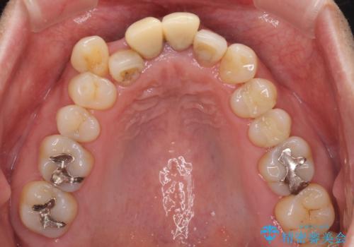 八重歯と突出感を改善 ワイヤー装置での矯正治療の治療前