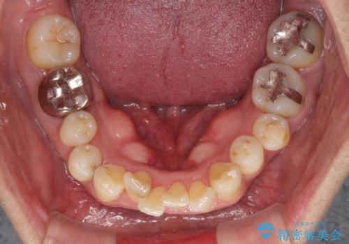 八重歯と突出感を改善 ワイヤー装置での矯正治療の治療前