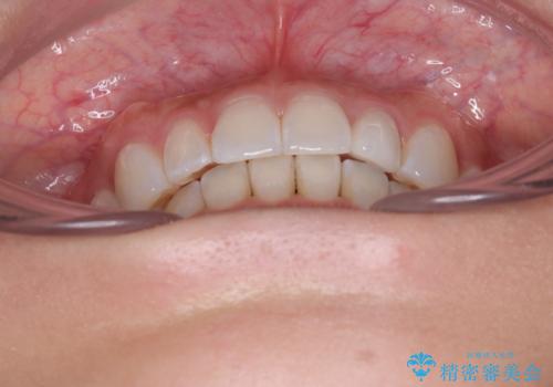 【モニター】前歯のデコボコと小さい前歯 インビザライン矯正とオールセラミッククラウン補綴治療の治療後