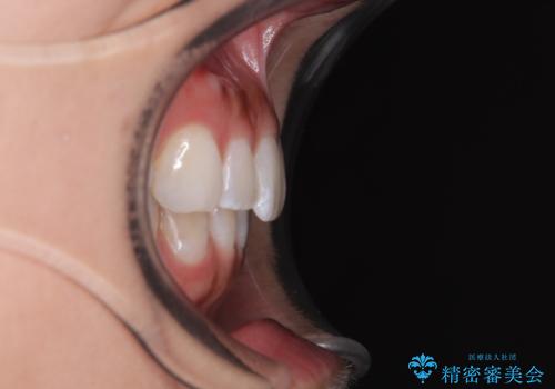 【モニター】前歯のデコボコと小さい前歯 インビザライン矯正とオールセラミッククラウン補綴治療の治療後