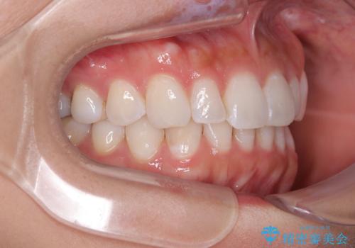 【モニター】前歯のデコボコと小さい前歯 インビザライン矯正とオールセラミッククラウン補綴治療の治療後