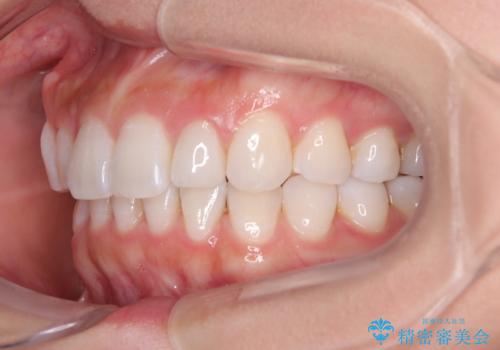 【モニター】前歯のデコボコと小さい前歯 インビザライン矯正とオールセラミッククラウン補綴治療の治療後