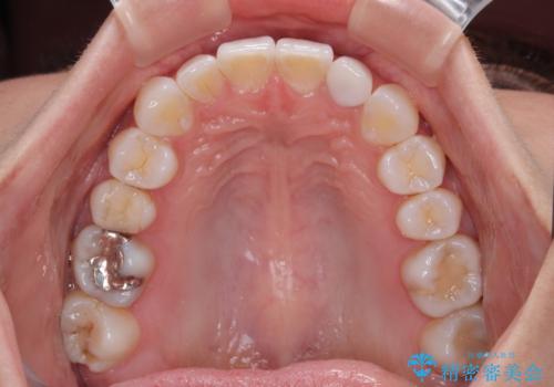 【モニター】前歯のデコボコと小さい前歯 インビザライン矯正とオールセラミッククラウン補綴治療の治療後