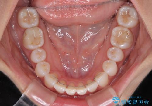 【モニター】前歯のデコボコと小さい前歯 インビザライン矯正とオールセラミッククラウン補綴治療の治療後
