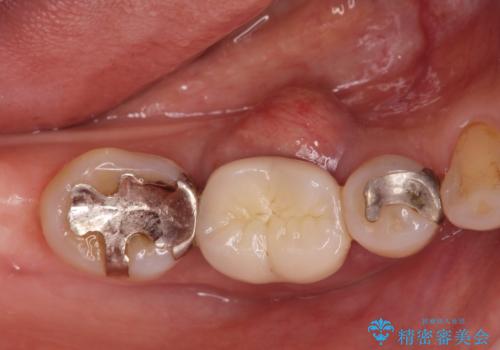 歯槽堤保存術 → インプラント治療の治療前
