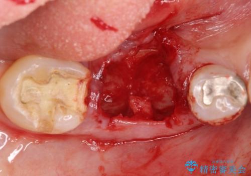 歯槽堤保存術 → インプラント治療の治療中