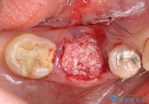 歯槽堤保存術 → インプラント治療の治療中