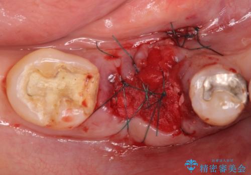 歯槽堤保存術 → インプラント治療の治療後