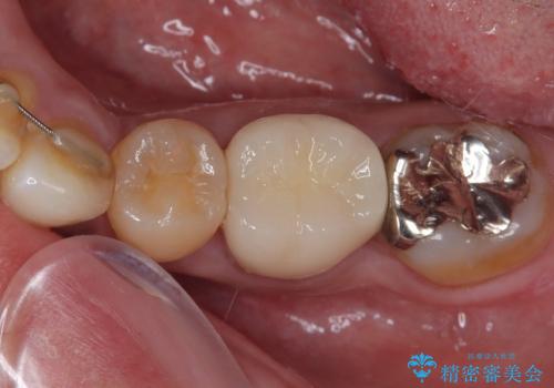 銀歯の入った歯が欠けた 奥歯のオールセラミッククラウン補綴治療
